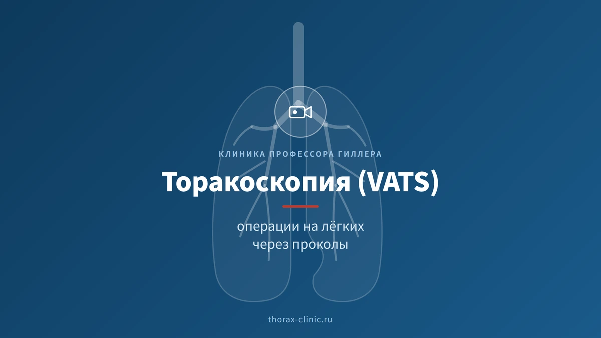 Торакоскопия и видеоторакоскопические операции: преимущества метода