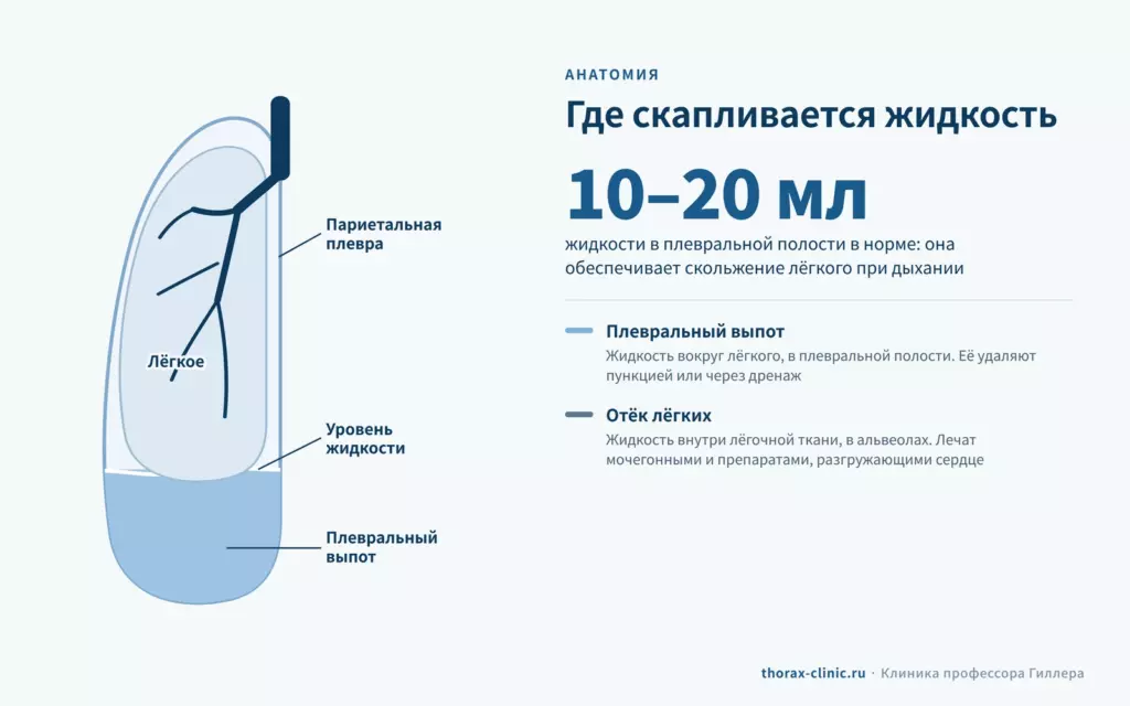 Схема плеврального выпота: жидкость скапливается между лёгким и грудной стенкой, в норме её 10–20 мл