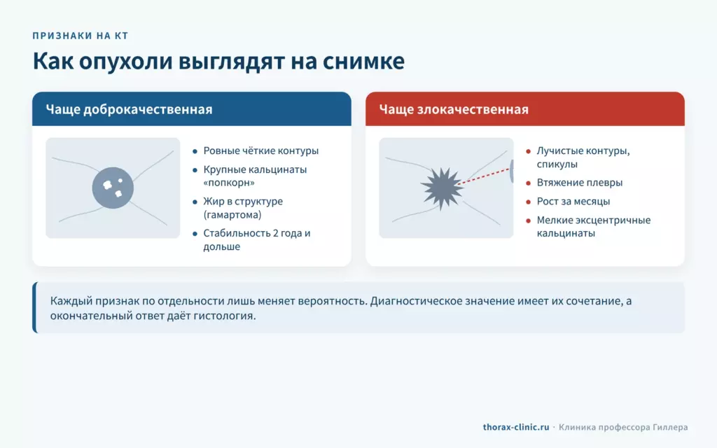 Признаки доброкачественной и злокачественной опухоли лёгкого на КТ: контуры, кальцинаты, спикулы, втяжение плевры