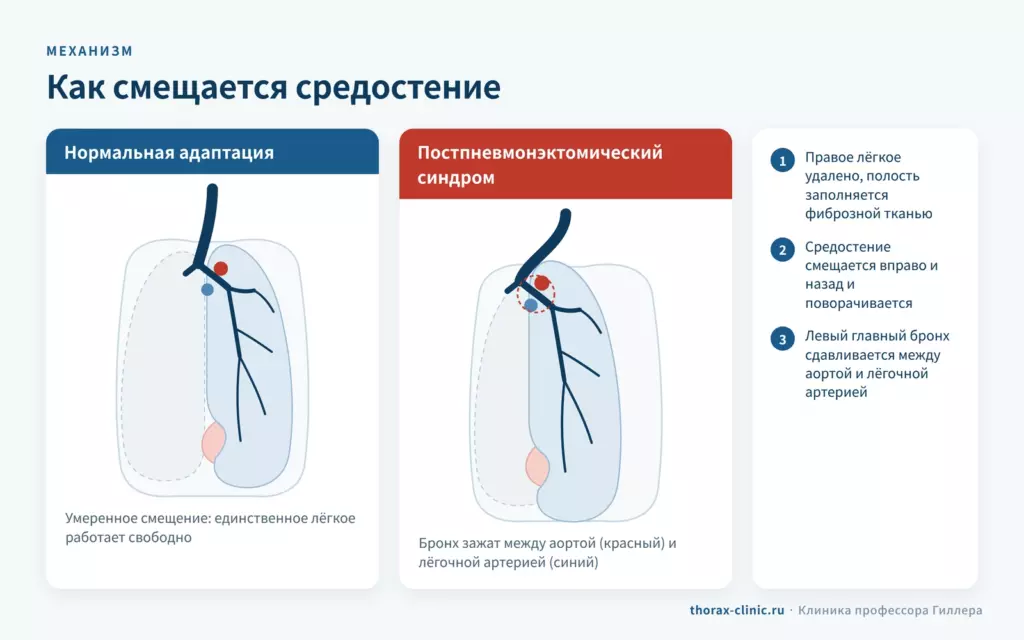 Механизм постпневмонэктомического синдрома: чрезмерное смещение средостения и сдавление бронха между аортой и лёгочной артерией