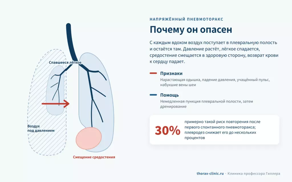 Схема напряжённого пневмоторакса: воздух под давлением, спавшееся лёгкое и смещение средостения