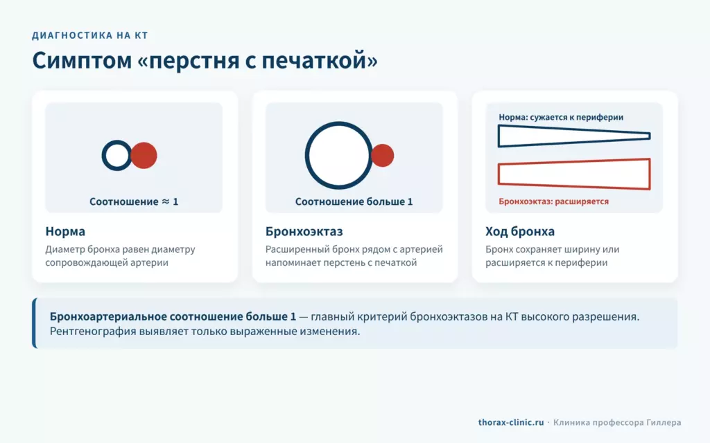Симптом перстня с печаткой на КТ: бронхоартериальное соотношение больше 1 — критерий бронхоэктазов