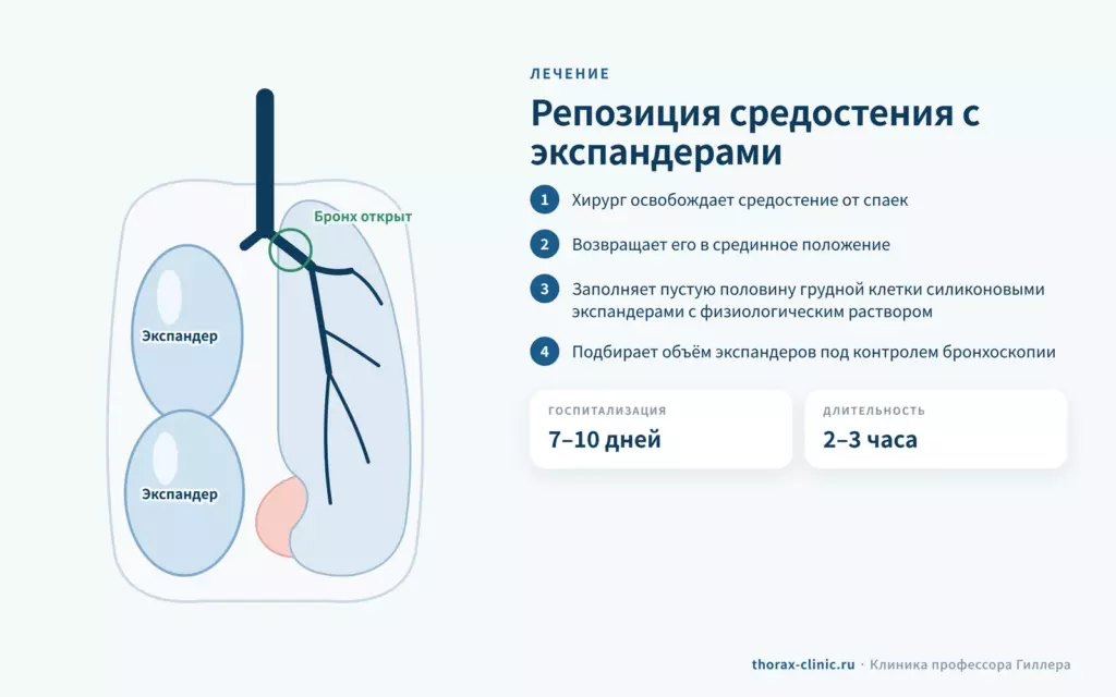 Лечение постпневмонэктомического синдрома: репозиция средостения и установка силиконовых экспандеров